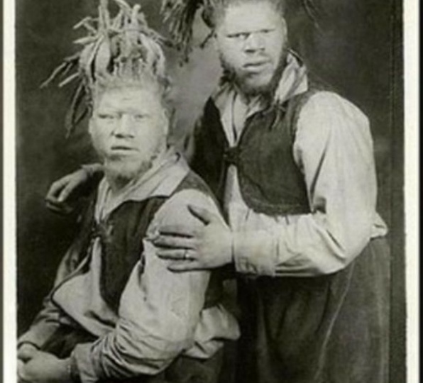 "Они что, с Марса": два несчастных брата, которых показывали за деньги. Как сложилась их судьба