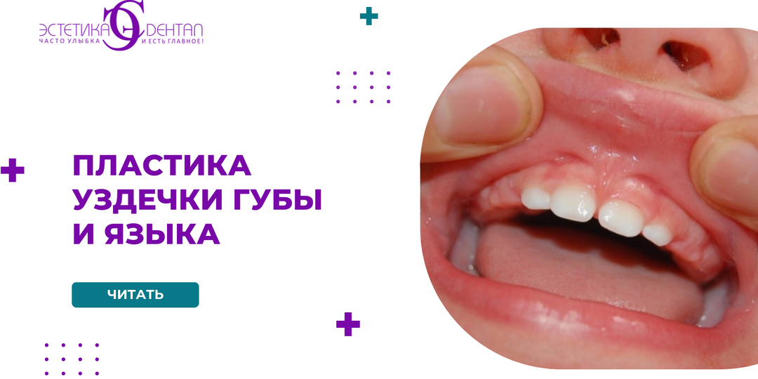 Пластика уздечки губы и языка: зачем детям и взрослым подрезать «связки» во рту и как это влияет на дикцию и прикус