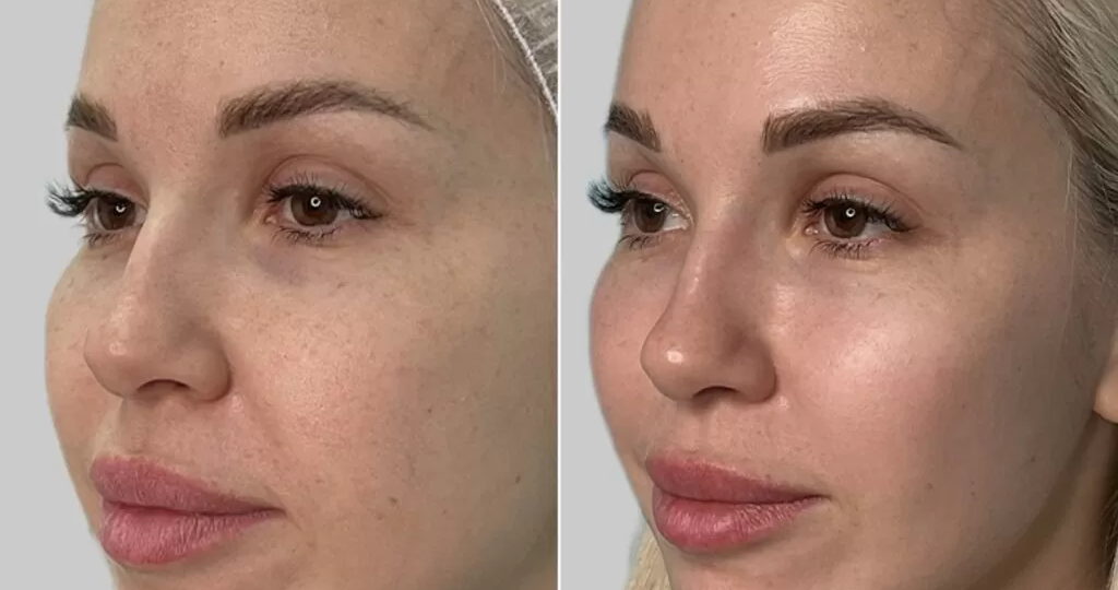 Биоревитализация Revi Strong: как работает формула с пептидами и антиоксидантами — и почему её выбирают для зрелой кожи