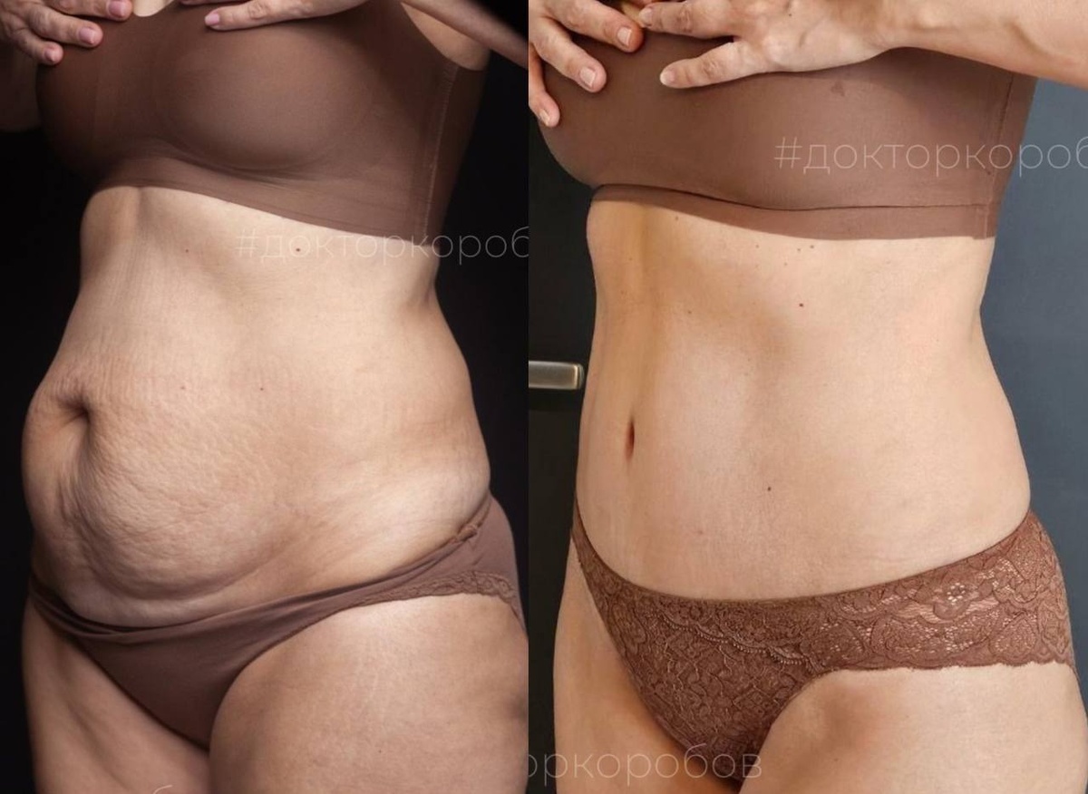 Выполнили абдоминопластику, липосакцию живота, липосакцию пояснично-боковых зон не делали. Результат через 2 месяца после операции.