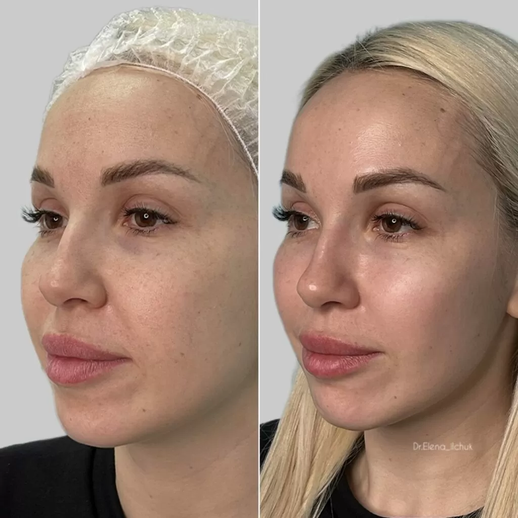 Результат после процедуры