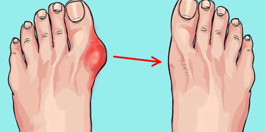 Скажите нет своим косточкам на больших пальцах стоп: 3 правила и 3 практики, которые стоит попробовать