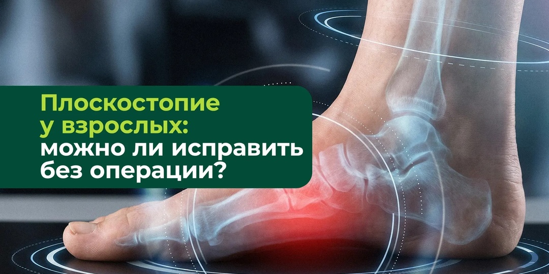 Плоскостопие у взрослых: можно ли исправить без операции? Честный ответ ортопеда