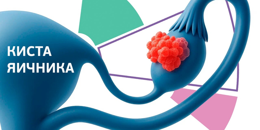 Киста яичника. Развеем все мифы