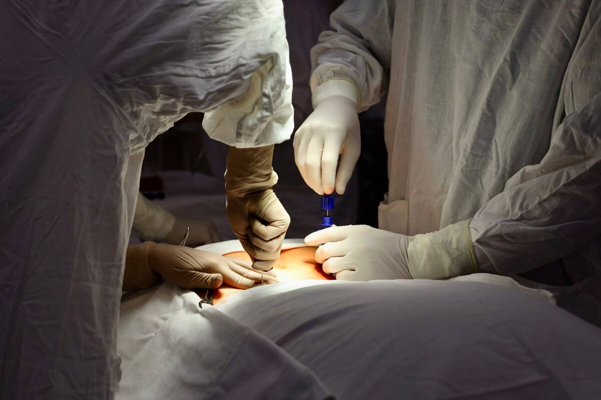 Процесс забора стволовых клеток костного мозга методом эксфузии. Источник: https://new.nmicr.ru/en/news/nmrrc-has-started-performing-bone-marrow-harvesting/