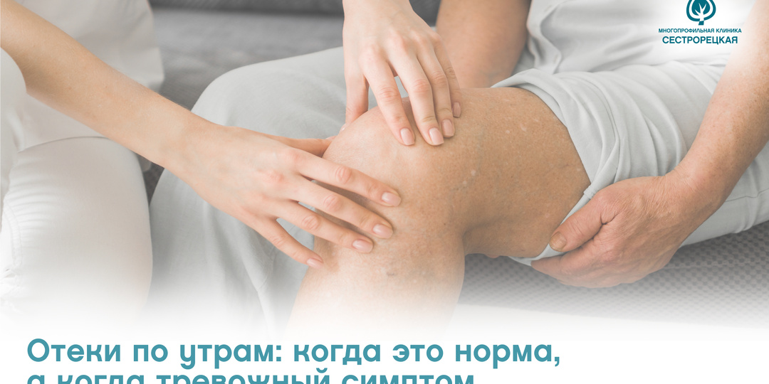 Отеки по утрам: когда это норма, а когда тревожный симптом