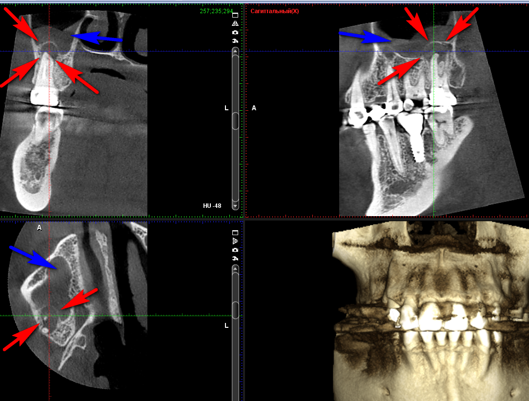 Синей стрелкой обозначена воспаленная слизистая в гайморовой пазухе, красными стрелками - очаг воспаления вокруг корня, который и вызывает воспаление слизистой пазухи. Было проведено перелечивание корневых каналов в зубе, на следующем снимке контрольный снимок через 6 мес, листатйте галерею    