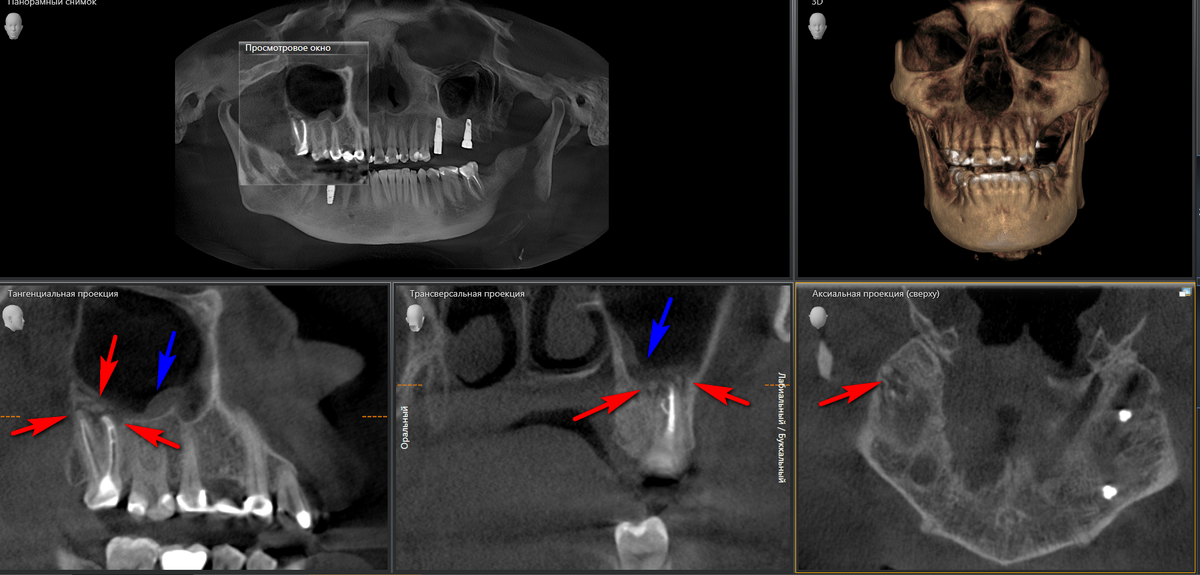 После проведенного перелечивания на контрольном снимке очаг воспаления вокруг корня практически полностью зажил (красные стрелки), слизистая пазухи еще сохраняет незначительное остаточнрое воспаление (синяя стрелка). Пациентка отмечает значительное улучшение самочувствия и отсутствие ранее беспокоящей заложенности носа справа. 