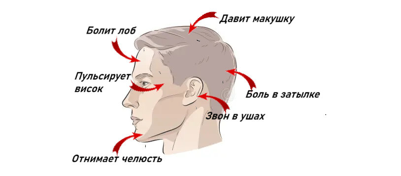 Карта боли головы: как определить причину головной боли по месту - разбор от невролога