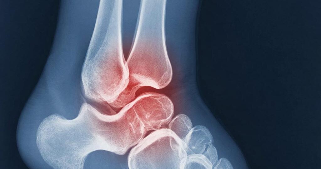 Эти обеды помогут вам справиться с подагрой