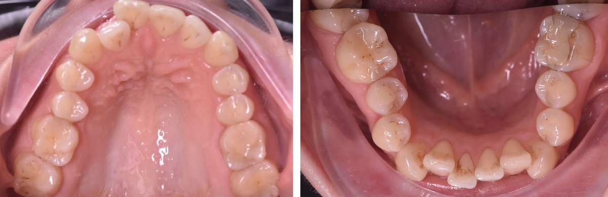 Сужение челюстей