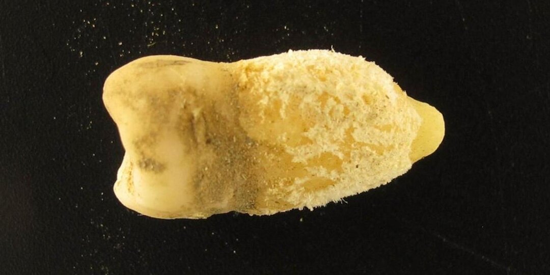 Зуб боливийской мумии помог узнать, откуда в Америке появилась скарлатина