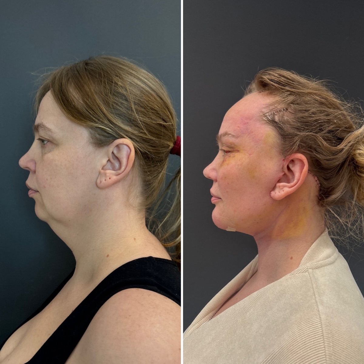 Комплексное омоложение лица и шеи: 10 дней после операции ( слева- до, справа- после). Пластический хирург Остринская Т. В.