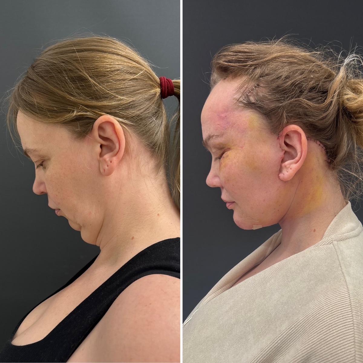 Комплексное омоложение лица и шеи: 10 дней после операции ( слева- до, справа- после). Пластический хирург Остринская Т. В.