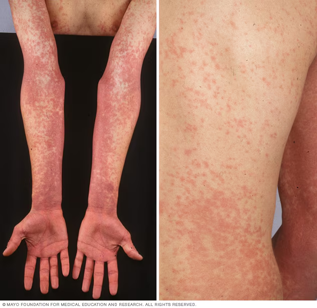 фото с сайта: https://www.mayoclinic.org