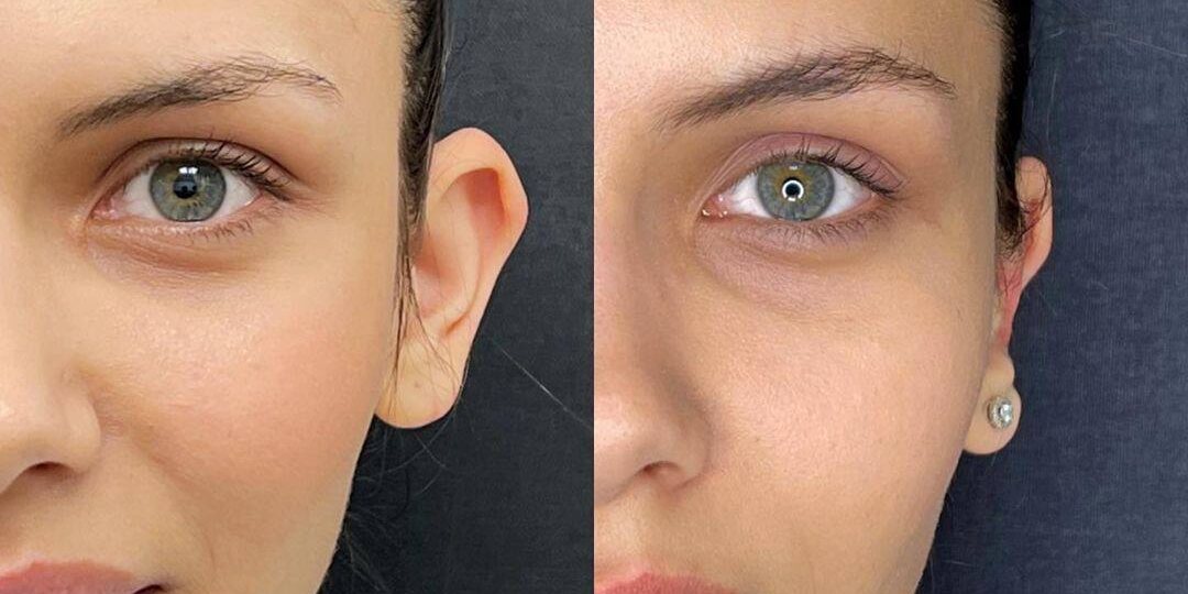 Уши торчат? 5 мифов об отопластике, из-за которых вы годами прячете уши под волосами и повязками