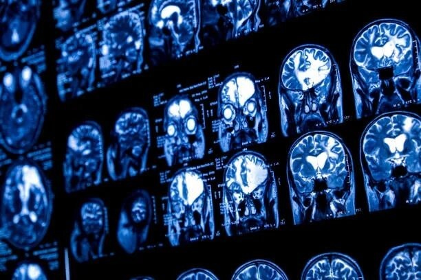 Результат удивил даже самих авторов работы: Мозг способен восстанавливаться!