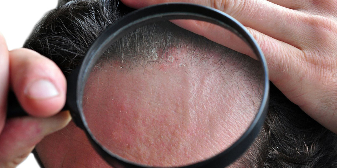 Себорея: причины, симптомы и методы лечения себорейного дерматита