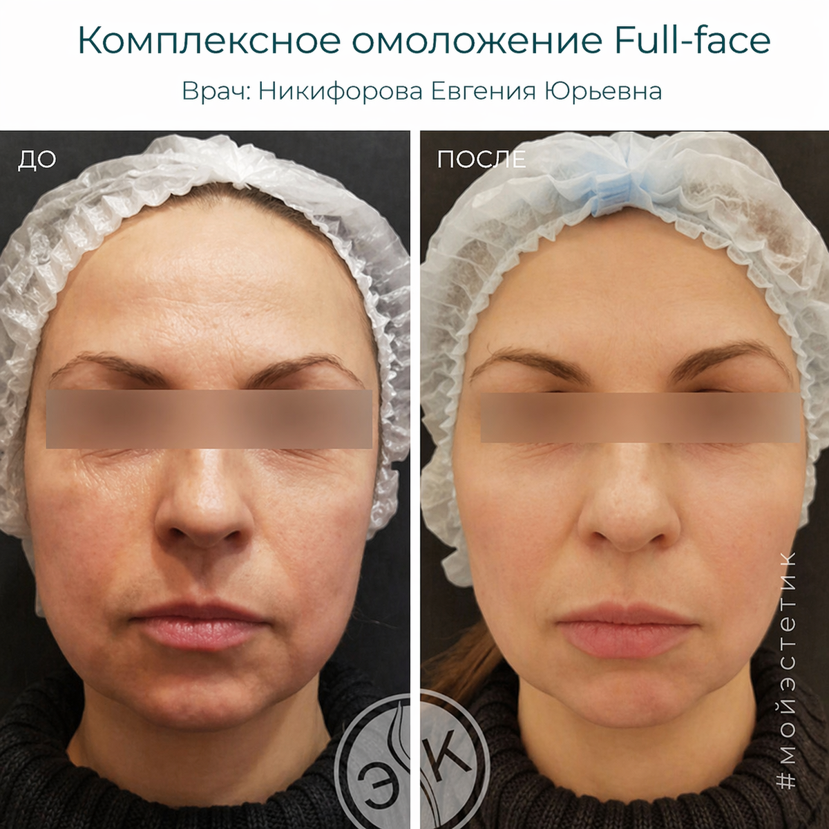 Результат процедуры Full face (фото принадлежит Никифоровой Е.Ю.)