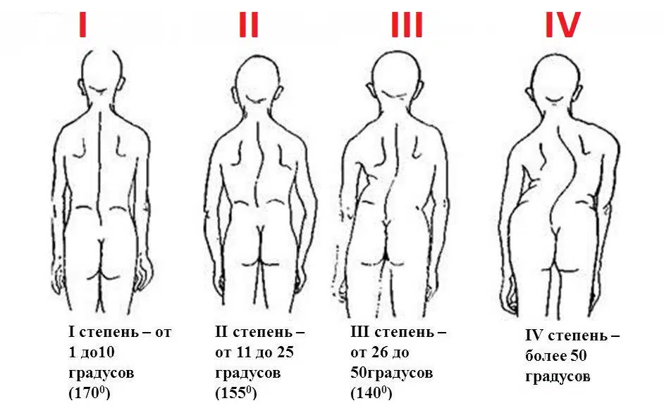 Степени сколиоза