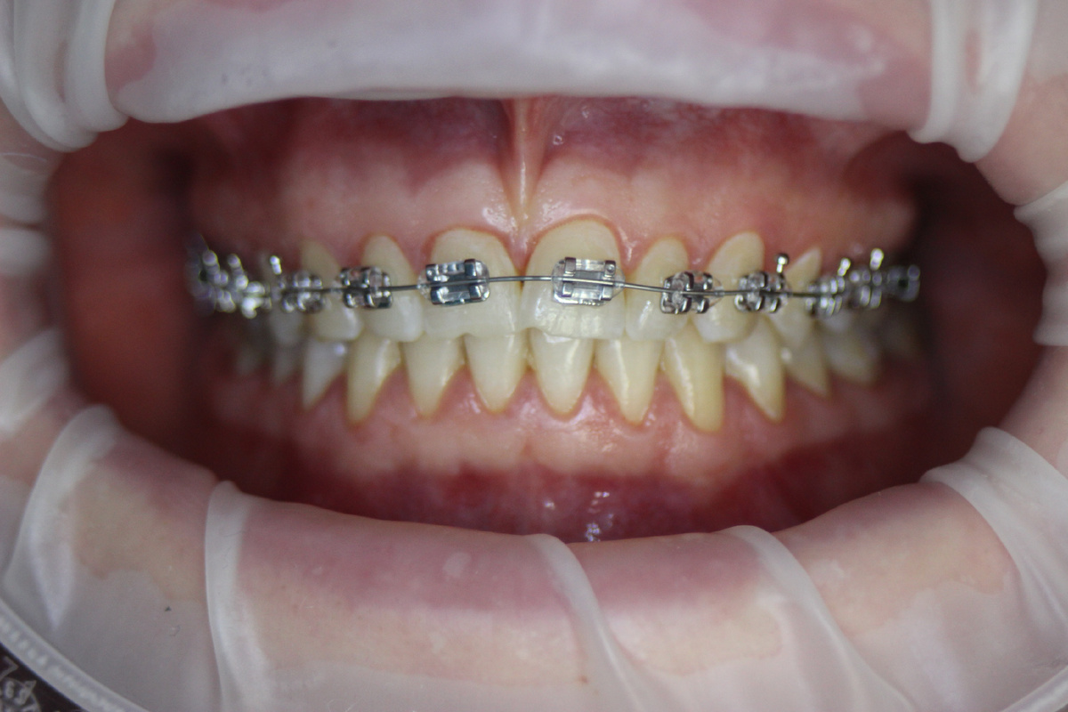 Стоматология Премоляр