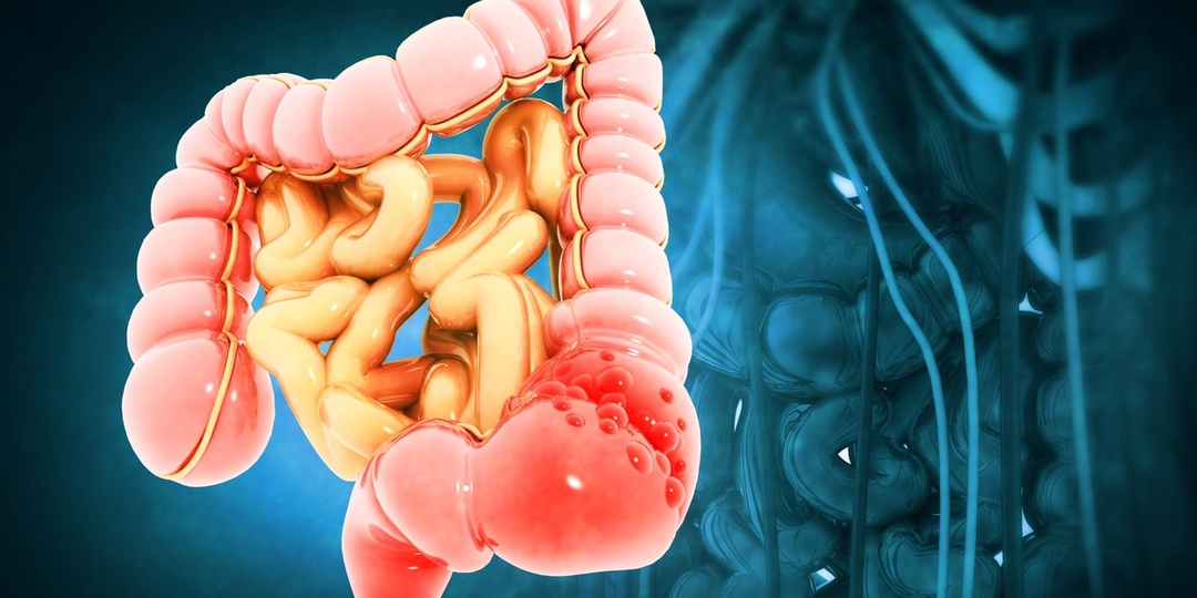 Симптомы Рака Кишечника На Ранней Стадии Без Боли