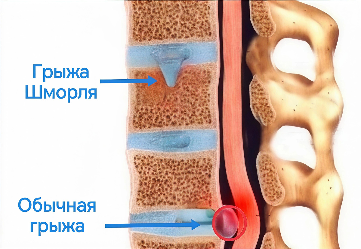 Схематичное изображение отличия грыжи Шморля