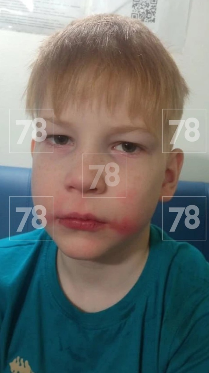 Мальчик, после его "спасения" органами опеки https://vk.com/nasha_nevskaya_zastava?w=wall-182004849_13197