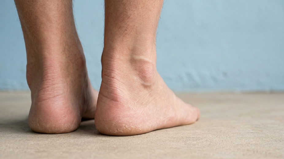 7 признаков на пятках, которые не стоит игнорировать