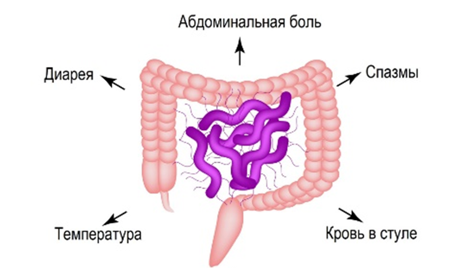 Кампилобактериоз: скрытая кишечная инфекция из мяса птицы