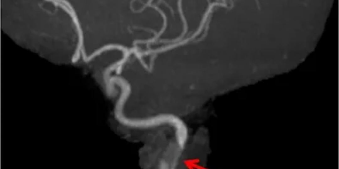 Как перкуссионный массажёр едва не убил человека