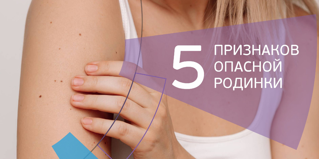 5 признаков опасной родинки. Проверьте себя за 1 минуту