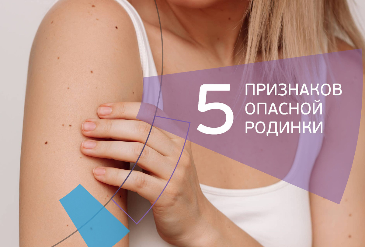 5 признаков опасной родинки. Проверьте себя за 1 минуту