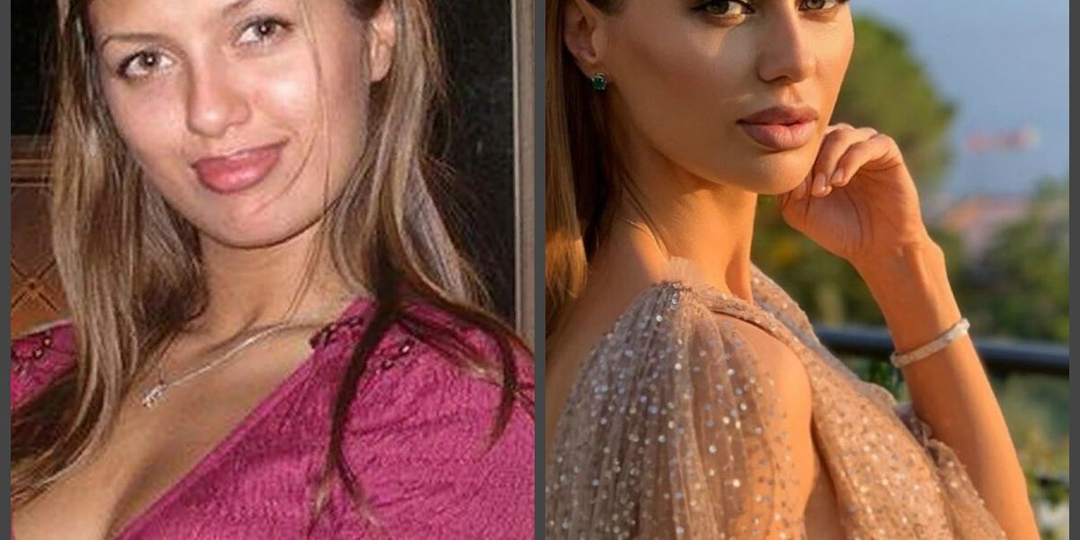 Российские звезды, которых не узнать после пластики. Их внешность до и после