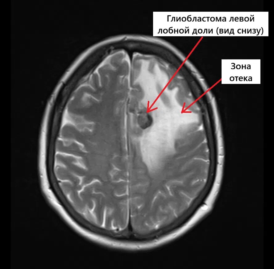 МРТ головного мозга пациентки с глиобластомой левой лобной доли (вид снизу)