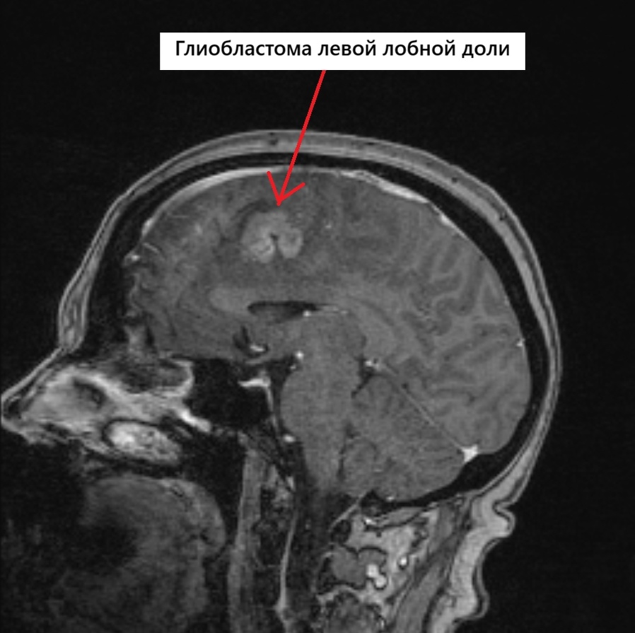 МРТ головного мозга пациентки с глиобластомой левой лобной доли (вид сбоку)