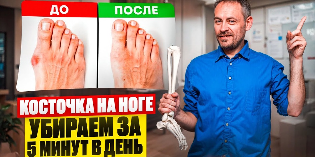 Как убрать косточку на ноге за 5 минут | Причины и последствия Халюс Вальгус