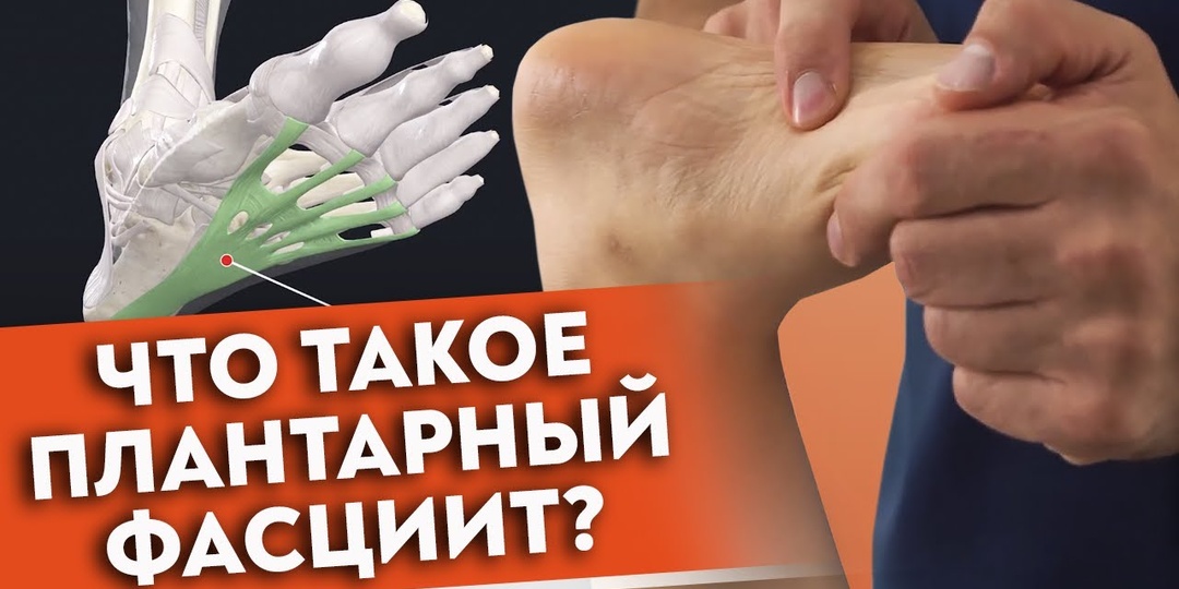 Болит пятка — что делать? Плантарный фасциит: причины заболевания и срочная самопомощь
