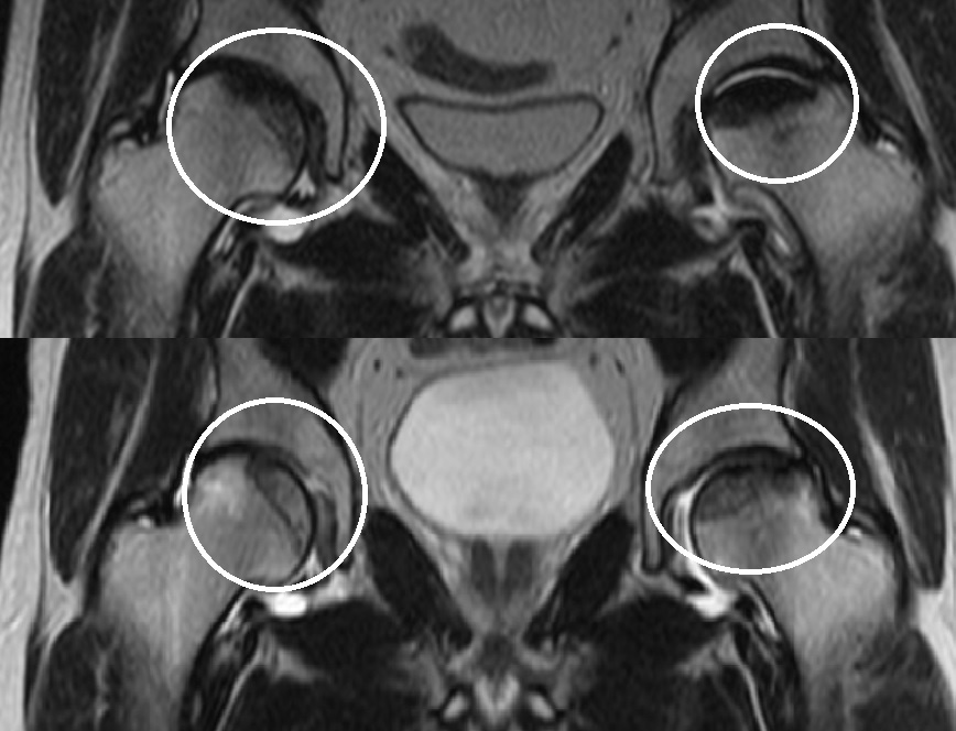Асептический некроз тазобедренного сустава с разрушением участка кости в течении года при несоблюдении охранительного режима - постельный режим или использование костылей 