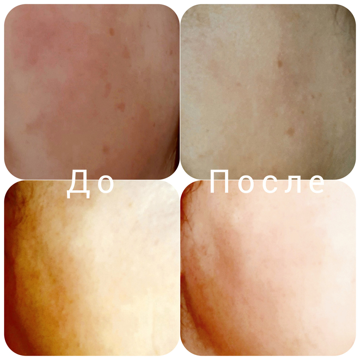 Пигментация