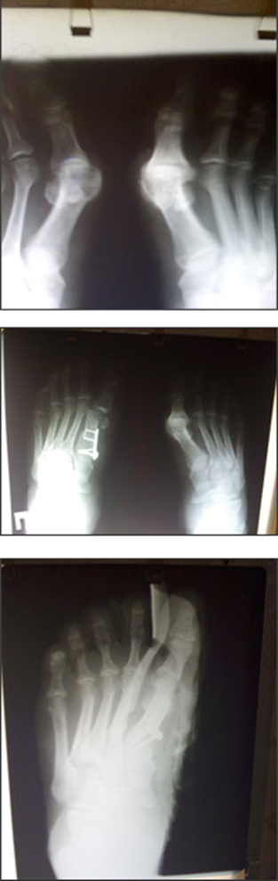 Оперативное лечени HALUS VALGUS