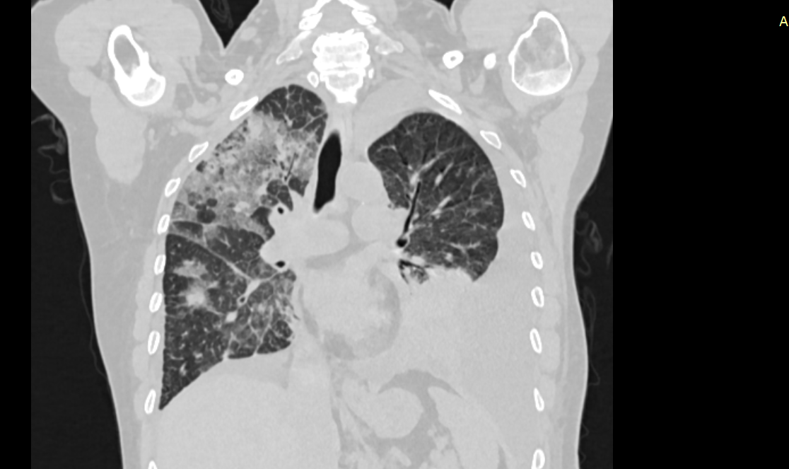 КТ органов грудной клетки, на снимке легко оценить степень поражения легочной ткани.