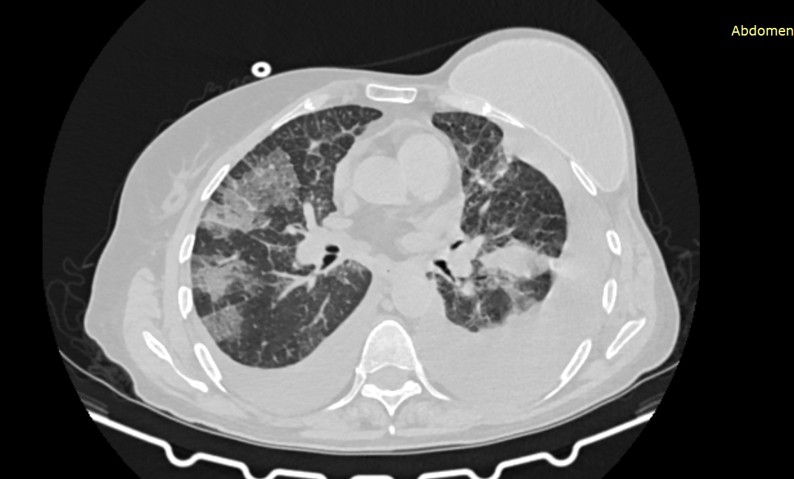 Компьютерная томография легких, на снимке отчетливо видна двусторонняя пневмония, скопление свободной жидкости в легких, также виден имплант, установленный после удаления молочной железы