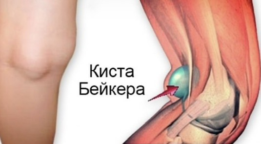 Киста Бейкера: почему ее не надо лечить?