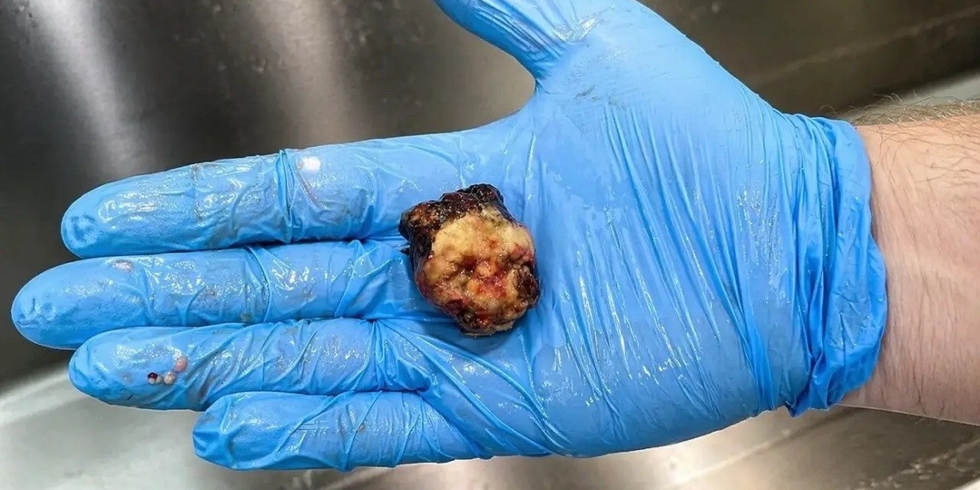 Красноярские врачи спасли пациентку с осложнением желчнокаменной болезни