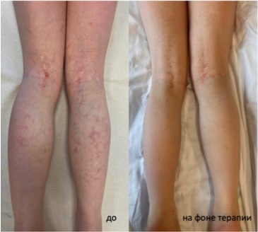 🏥 Нет тупиковых ситуаций, есть непростые решения: ювенильный дерматомиозит