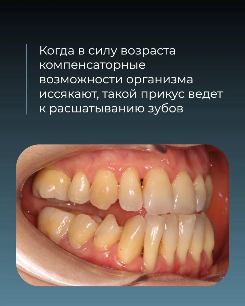 Листайте галерею, чтобы понять масштаб рисков такого прикуса