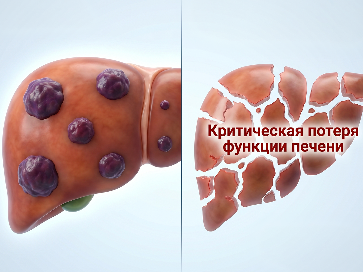 При множественных метастазах, 3 и более, в печени или почках полное хирургическое удаление также часто невозможно без критической потери функции органа
