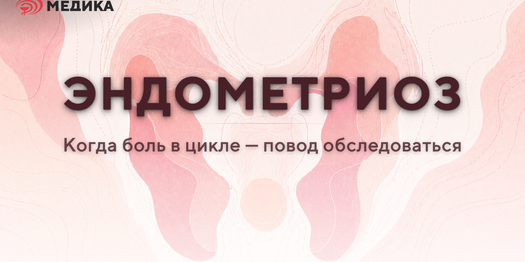 Эндометриоз: когда боль в цикле — повод обследоваться