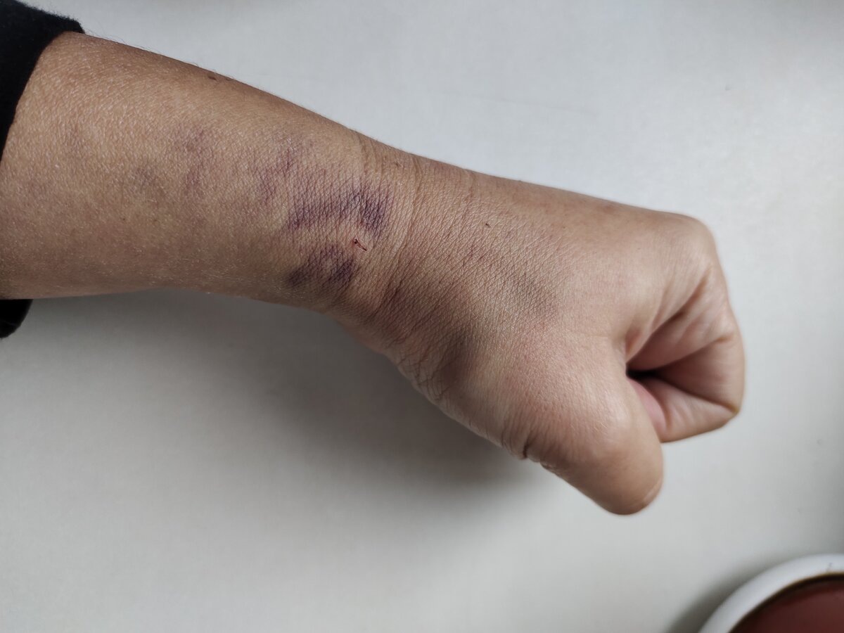 Результат безуспешной попытки поставить катетер 